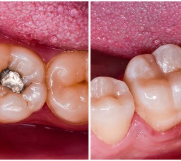 Tooth Filling With Composite